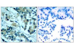 Immunohistochemical analysis of paraffin-embedded human lung carcinoma tissue, using MEK1 (Ab-217) antibody (E021203). (MEK1 抗体)