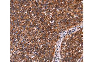 Immunohistochemistry of Human colon cancer using CCDC106 Polyclonal Antibody at dilution of 1:60 (CCDC106 抗体)