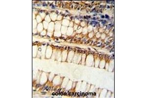 Formalin-fixed and paraffin-embedded human colon carcinoma reacted with BCL2L11 Antibody (Center), which was peroxidase-conjugated to the secondary antibody, followed by DAB staining. (BIM 抗体  (AA 134-160))