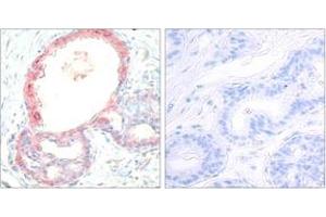 Immunohistochemistry analysis of paraffin-embedded human breast carcinoma, using Rel (Phospho-Ser503) Antibody. (c-Rel 抗体  (pSer503))