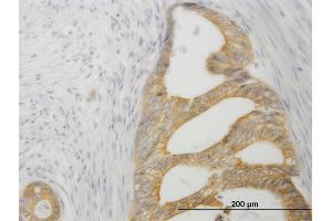 Immunoperoxidase of monoclonal antibody to TNFRSF14 on formalin-fixed paraffin-embedded human pancreatic cancer. (HVEM 抗体  (AA 38-283))
