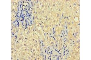 Immunohistochemistry of paraffin-embedded human liver cancer using ABIN7176291 at dilution of 1:100 (Zinc Finger Protein 44 抗体  (AA 1-300))