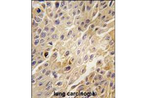 Formalin-fixed and paraffin-embedded human lung carcinoma tissue reacted with GRK2 Antibody , which was peroxidase-conjugated to the secondary antibody, followed by DAB staining.