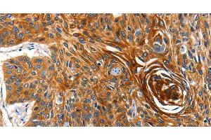 Immunohistochemistry of paraffin-embedded Human esophagus cancer tissue using AQP5 Polyclonal Antibody at dilution 1:40 (Aquaporin 5 抗体)