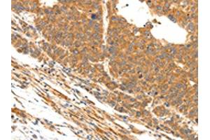 The image on the left is immunohistochemistry of paraffin-embedded Human liver cancer tissue using ABIN7190491(DOPEY1 Antibody) at dilution 1/25, on the right is treated with synthetic peptide. (DOPEY1 抗体)