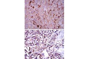 Immunohistochemical analysis of paraffin-embedded human ovarian cancer (upper) and human stomach cancer (bottom) tissues using G6PD monoclonal antibody, clone 5E12  with DAB staining. (Glucose-6-Phosphate Dehydrogenase 抗体)