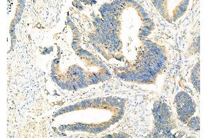 ABIN6265121 and ABIN6273320 at 1/100 staining Human colorectal cancer by IHC-P. (SLC25A46 抗体  (N-Term))