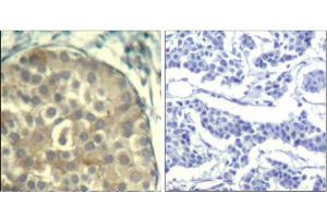 Immunohistochemical analysis of paraffin-embedded human breast carcinoma tissue using cofilin1/cofilin2 (phospho-Tyr88) Antibody (E011507). (Cofilin1/2 (CFL1/2) (pTyr88) 抗体)