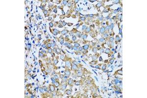 Immunohistochemistry of paraffin-embedded human lung cancer using OGDH antibody (ABIN5973793) at dilution of 1/100 (40x lens).