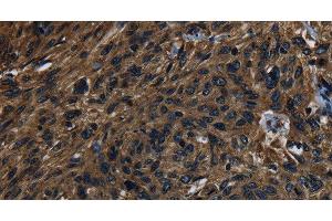 Immunohistochemistry of paraffin-embedded Human esophagus cancer using KLK14 Polyclonal Antibody at dilution of 1:40 (Kallikrein 14 抗体)