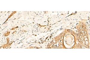 Immunohistochemistry of paraffin-embedded Human esophagus cancer tissue using EIF3C Polyclonal Antibody at dilution of 1:35(x200) (EIF3C 抗体)