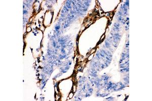 Anti- HSP27 antibody, IHC(P) IHC(P): Human Intestinal Cancer Tissue (HSP27 抗体  (AA 1-205))