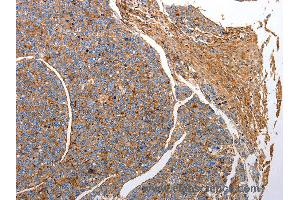 Immunohistochemistry of Human liver cancer using CD151 Polyclonal Antibody at dilution of 1:25 (CD151 抗体)