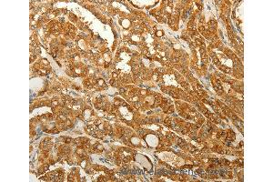 Immunohistochemistry of Human liver cancer using RAB35 Polyclonal Antibody at dilution of 1:50 (RAB35 抗体)