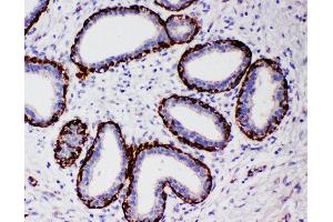 Anti-Arg2 antibody, IHC(P) IHC(P): Human Mammary Cancer Tissue
