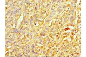 Immunohistochemistry of paraffin-embedded human melanoma using ABIN7151313 at dilution of 1:100 (XIAP 抗体  (AA 1-200))