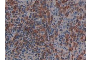 Detection of LAT2 in Human Skin cancer Tissue using Polyclonal Antibody to Linker For Activation Of T-Cells Family, Member 2 (LAT2) (LAT2 抗体  (AA 30-209))