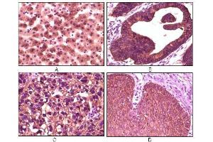 Immunohistochemical analysis of paraffin-embedded human liver tissue (A), colon carcinoma (B), lung carcinoma (C) and esophagus tissue (D), showing membrane localization using CK1 antibody with DAB staining. (CSNK1A1 抗体)
