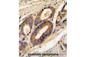 ATP6V0B Antibody (Center) immunohistochemistry analysis in formalin fixed and paraffin embedded human prostate carcinoma followed by peroxidase conjugation of the secondary antibody and DAB staining.