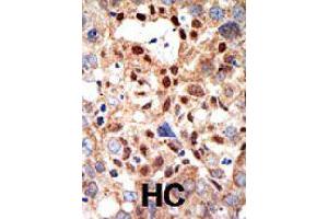 Formalin-fixed and paraffin-embedded human hepatocellular carcinoma tissue reacted with PML polyclonal antibody  , which was peroxidase-conjugated to the secondary antibody, followed by DAB staining . (PML 抗体)