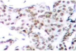 Immunohistochemistry (IHC) analyzes of p-STAT3 (pSer727) pAb in paraffin-embedded human breast carcinoma tissue. (STAT3 抗体  (pSer727))