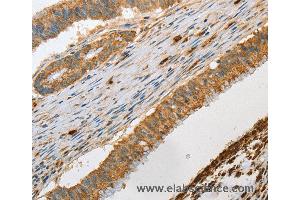 Immunohistochemistry of Human colon cancer using GZMB Polyclonal Antibody at dilution of 1:30 (GZMB 抗体)