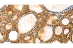 Immunohistochemistry of paraffin-embedded Human thyroid cancer using TMPRSS11F Polyclonal Antibody at dilution of 1:30 (TMPRSS11F 抗体)