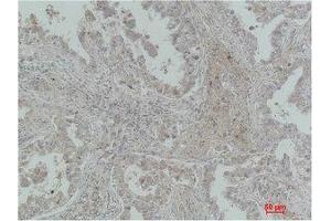 Immunohistochemistry (IHC) analysis of paraffin-embedded Human Lung Carcinoma using MICU1 Monoclonal Antibody. (MICU1 抗体)
