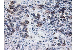 Immunohistochemical staining of paraffin-embedded Carcinoma of Human lung tissue using anti-PDE4B mouse monoclonal antibody. (PDE4B 抗体)