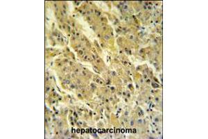 PSG7 Antibody IHC analysis in formalin fixed and paraffin embedded hepatocarcinoma followed by peroxidase conjugation of the secondary antibody and DAB staining. (PSG7 抗体  (C-Term))