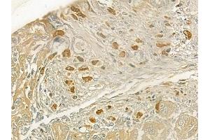 ABIN6258755 and ABIN6273696 at 1/100 staining human tongue carcinoma by IHC-P. (SETDB2 抗体  (N-Term))