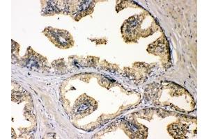IHC testing of FFPE human prostate cancer with DBI antibody at 1ug/ml. (Diazepam Binding Inhibitor 抗体  (AA 2-187))