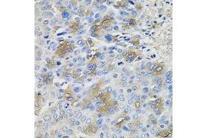 Immunohistochemistry of paraffin-embedded human liver cancer using SERPINA1 antibody. (SERPINA1 抗体  (AA 25-315))