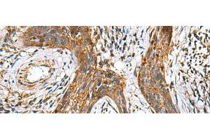 Immunohistochemistry of paraffin-embedded Human esophagus cancer tissue using TTR Polyclonal Antibody at dilution of 1:50(x200) (TTR 抗体)