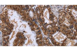 Immunohistochemistry of paraffin-embedded Human esophagus cancer using LTA4H Polyclonal Antibody at dilution of 1:30 (LTA4H 抗体)
