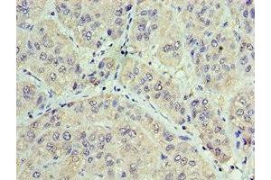 Immunohistochemistry of paraffin-embedded human liver cancer using ABIN7153848 at dilution of 1:100 (GAN 抗体  (AA 1-240))