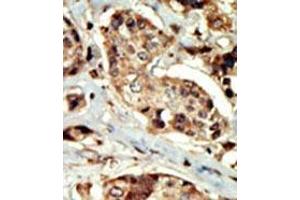 Formalin-fixed and paraffin-embedded human cancer tissue (breast carcinoma) reacted with the primary antibody, which was peroxidase-conjugated to the secondary antibody, followed by DAB staining. (STK16 抗体  (N-Term))