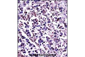 CN11 Antibody (Center) (13870c)immunohistochemistry analysis in formalin fixed and paraffin embedded human testis carcinoma followed by peroxidase conjugation of the secondary antibody and DAB staining. (CAPN11 抗体  (AA 409-438))