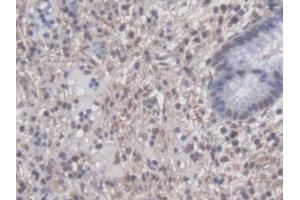 DAB staining on IHC-P; Samples: Human Colorectal cancer Tissue (PTTG1 抗体  (AA 2-202))