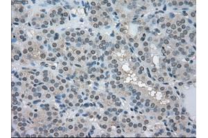 Immunohistochemical staining of paraffin-embedded Carcinoma of pancreas tissue using anti-LDHAmouse monoclonal antibody. (Lactate Dehydrogenase A 抗体)