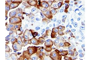 Formalin-fixed, paraffin-embedded human Melanoma stained with NGFR Mouse Monoclonal Antibody (NGFR5). (NGFR 抗体)