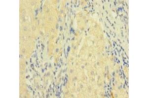 Immunohistochemistry of paraffin-embedded human liver cancer using ABIN7173813 at dilution of 1:100 (FASL 抗体  (AA 103-281))