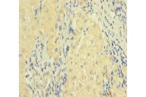Immunohistochemistry of paraffin-embedded human liver cancer using ABIN7173813 at dilution of 1:100 (FASL 抗体  (AA 103-281))