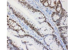 IHC-P: MCM2 antibody testing of human intestinal cancer tissue (MCM2 抗体  (C-Term))