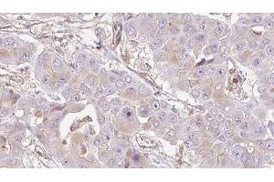 ABIN6272726 at 1/100 staining Human liver cancer tissue by IHC-P. (OR4D5 抗体)