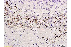 Formalin-fixed and paraffin embedded human endometrium carcinoma labeled with Anti-TIMP-4 Polyclonal Antibody, Unconjugated (ABIN668376) at 1:300, followed by conjugation to the secondary antibody and DAB staining (TIMP4 抗体  (AA 161-224))