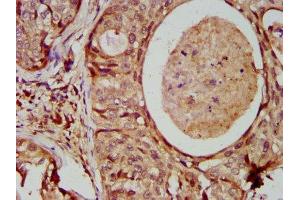 IHC image of ABIN7160090 diluted at 1:400 and staining in paraffin-embedded human cervical cancer performed on a Leica BondTM system.