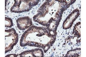 Immunohistochemical staining of paraffin-embedded Adenocarcinoma of Human colon tissue using anti-RFPL3 mouse monoclonal antibody. (RFPL3 抗体)