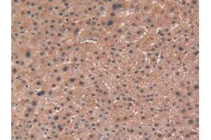IHC-P analysis of Human Liver Cancer Tissue, with DAB staining. (TEK 抗体  (AA 1-116))