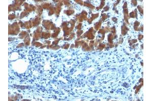 Formalin-fixed, paraffin-embedded human Hepatocellular Carcinoma stained with RBP1 (SPM442) (RBP4 抗体)